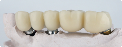 Dental prosthetic