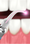 lasers for dentistry